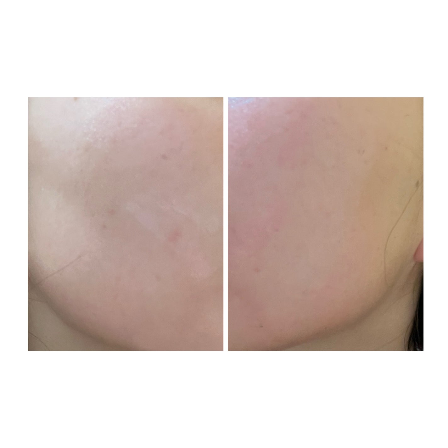 ぽむ on LIPS 「2023.9.13皮膚科に受診 エピデュオとヘパリン処方1枚目..」(5枚目)