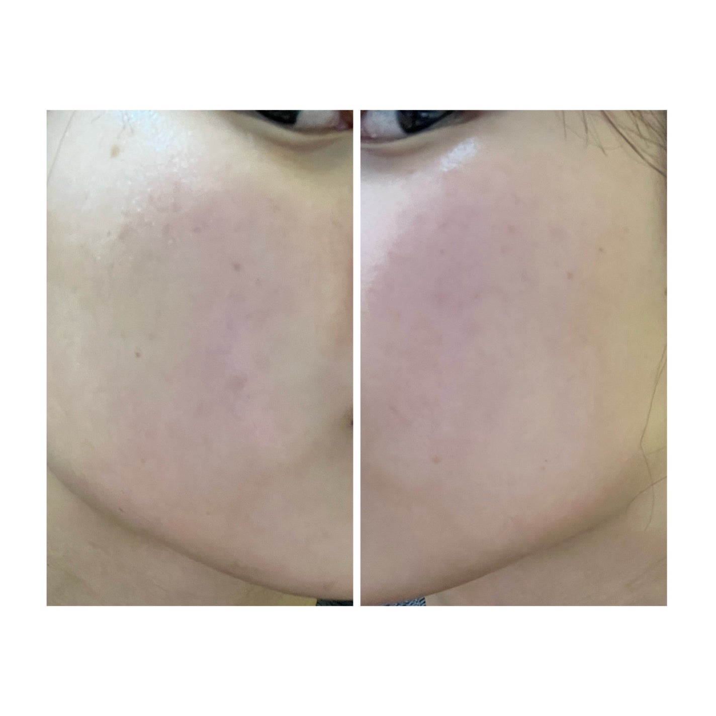 ぽむ on LIPS 「2023.9.13皮膚科に受診 エピデュオとヘパリン処方1枚目..」(3枚目)