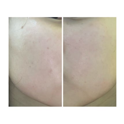 ぽむ on LIPS 「2023.9.13皮膚科に受診 エピデュオとヘパリン処方1枚目..」(4枚目)