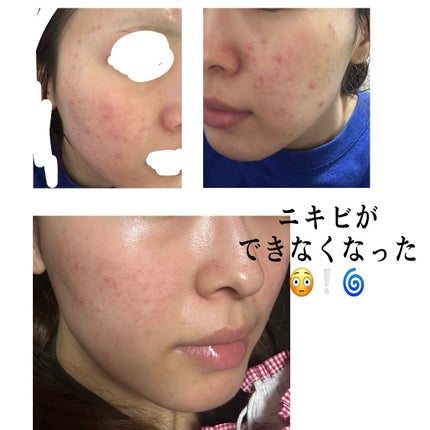 オードムーゲ 薬用ローション(ふきとり化粧水)/オードムーゲ/拭き取り化粧水を使ったクチコミ(2枚目)