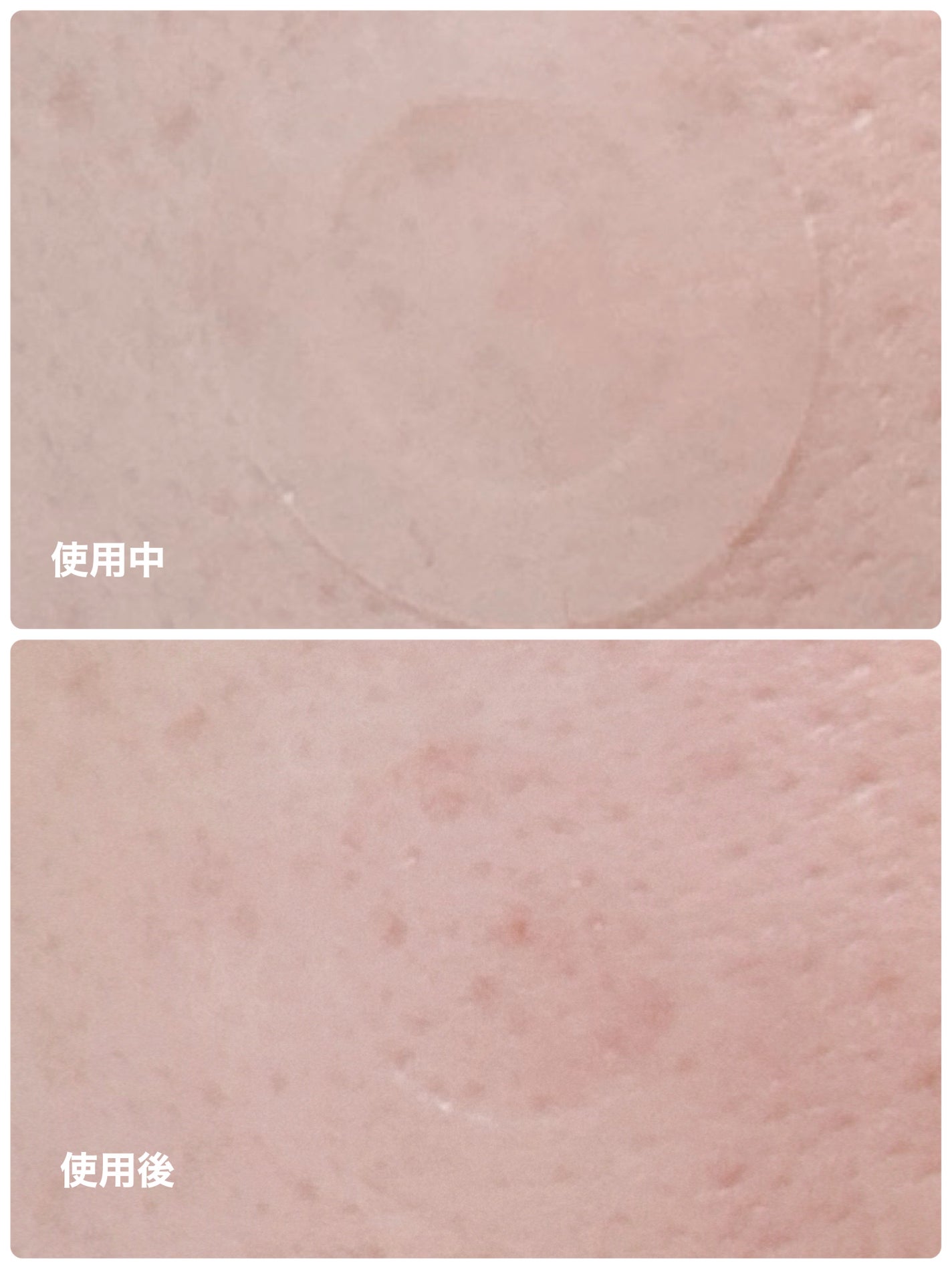 プロCICA クリアスポットパッチ/VT/その他スキンケアを使ったクチコミ(7枚目)