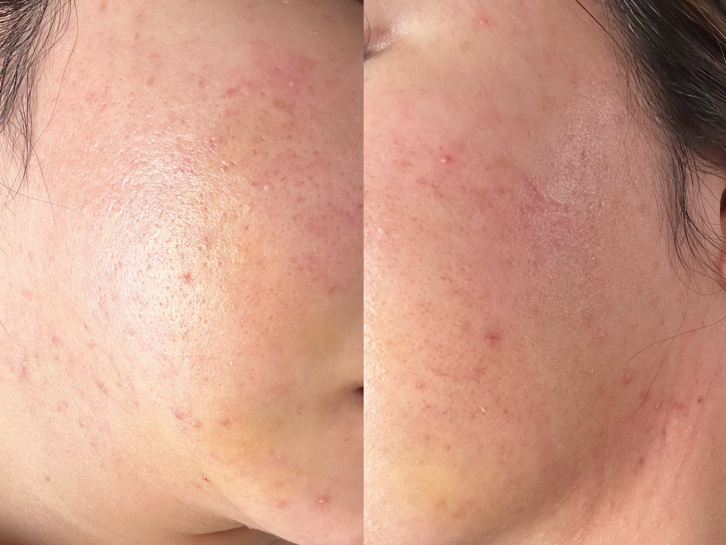 白潤プレミアム 薬用浸透美白化粧水(しっとりタイプ)/肌ラボ/化粧水を使ったクチコミ(1枚目)