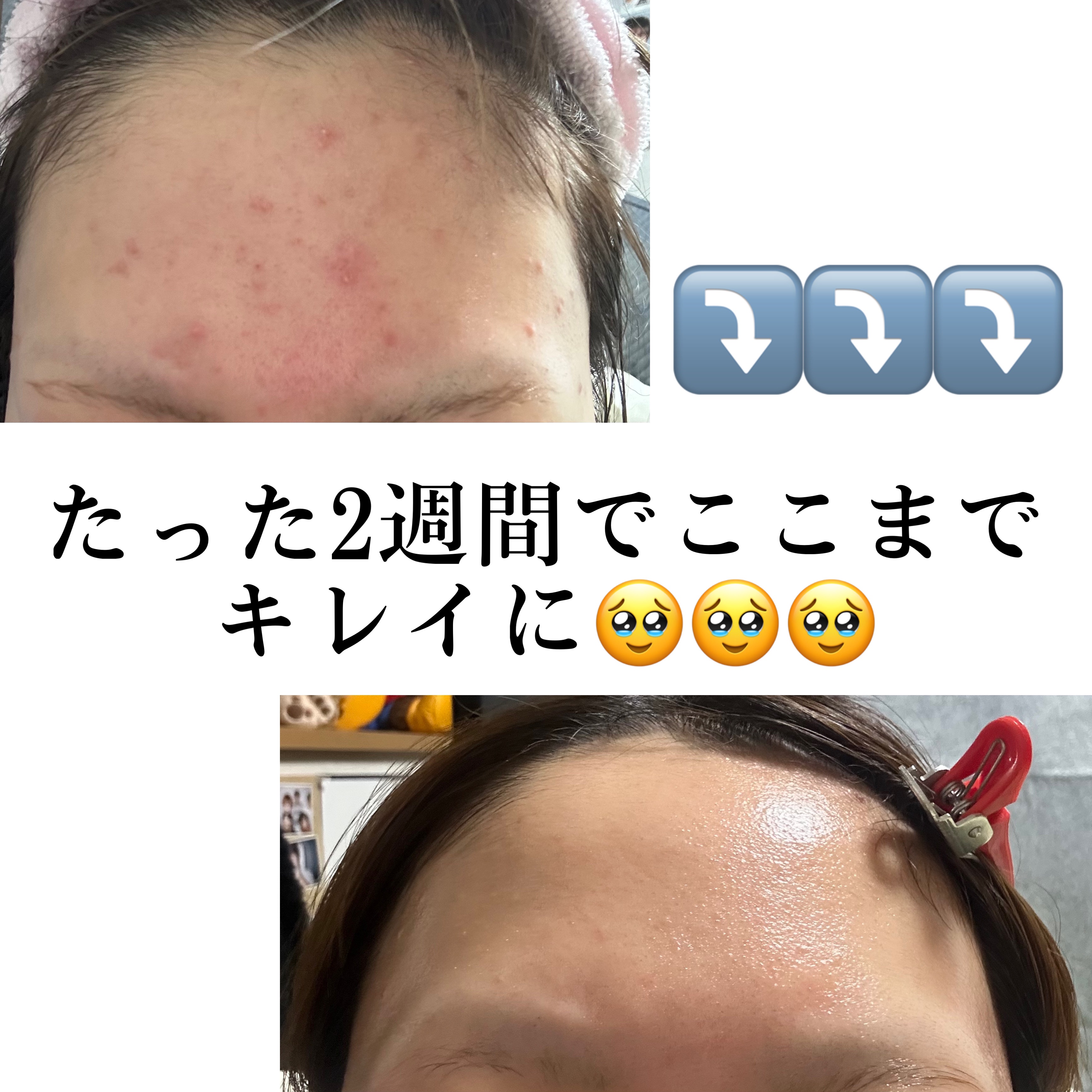 オードムーゲ 薬用ローション（ふきとり化粧水）/オードムーゲ/拭き取り化粧水を使ったクチコミ（1枚目）