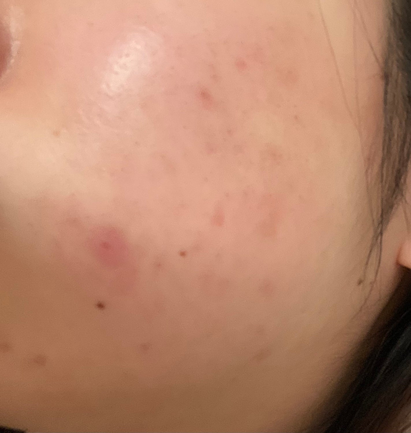 「肌荒れ治すぞ」ひよこ🐣フォロバ100 on LIPS 「🌸肌日記5日目ばたばたしてて投稿遅くなりました🙇♀️結構よく..」(1枚目)