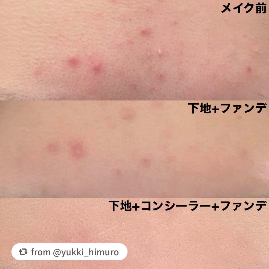 薬用コンシーラー アクネプロテクター/ONLY MINERALS/パウダーコンシーラーを使ったクチコミ(3枚目)