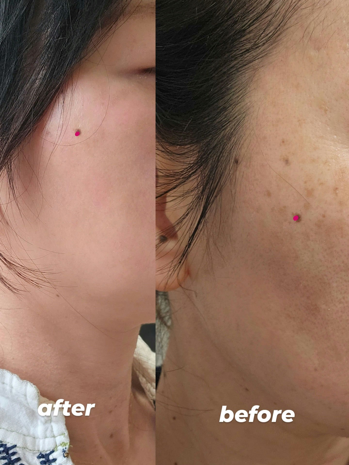 トラネキサム酸　250mg/東和薬品/その他を使ったクチコミ（2枚目）