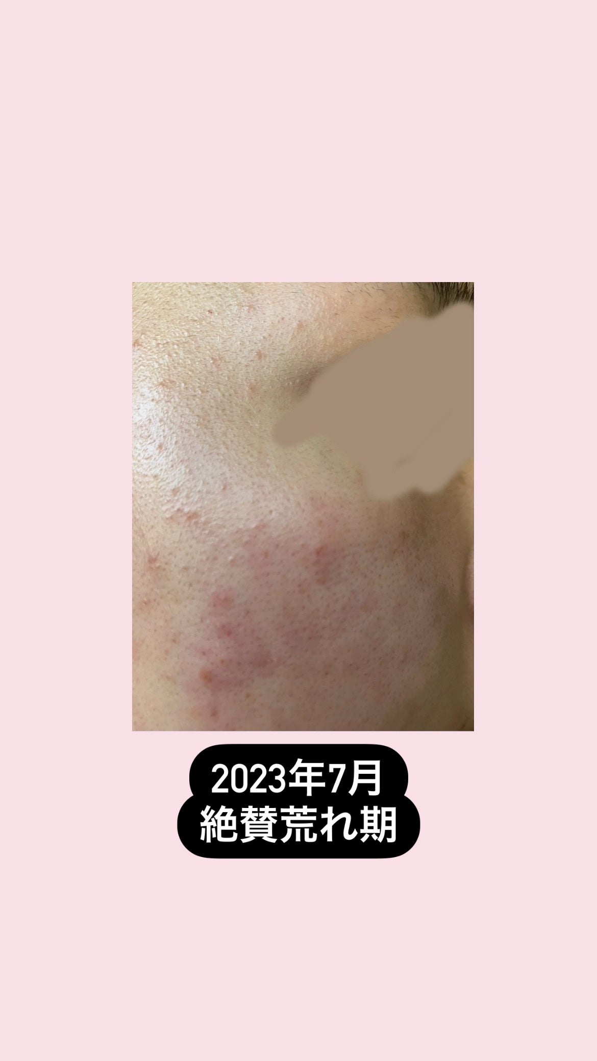 カラーミキシングコンシーラー/キャンメイク/パレットコンシーラーを使ったクチコミ(4枚目)