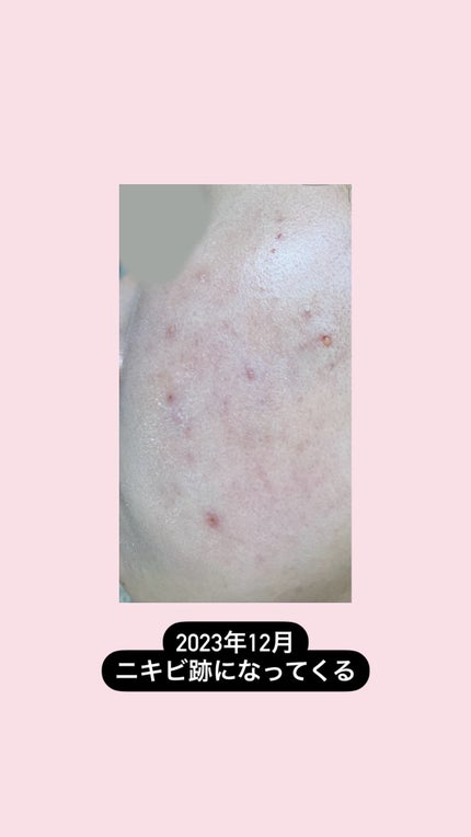 カラーミキシングコンシーラー/キャンメイク/パレットコンシーラーを使ったクチコミ(6枚目)