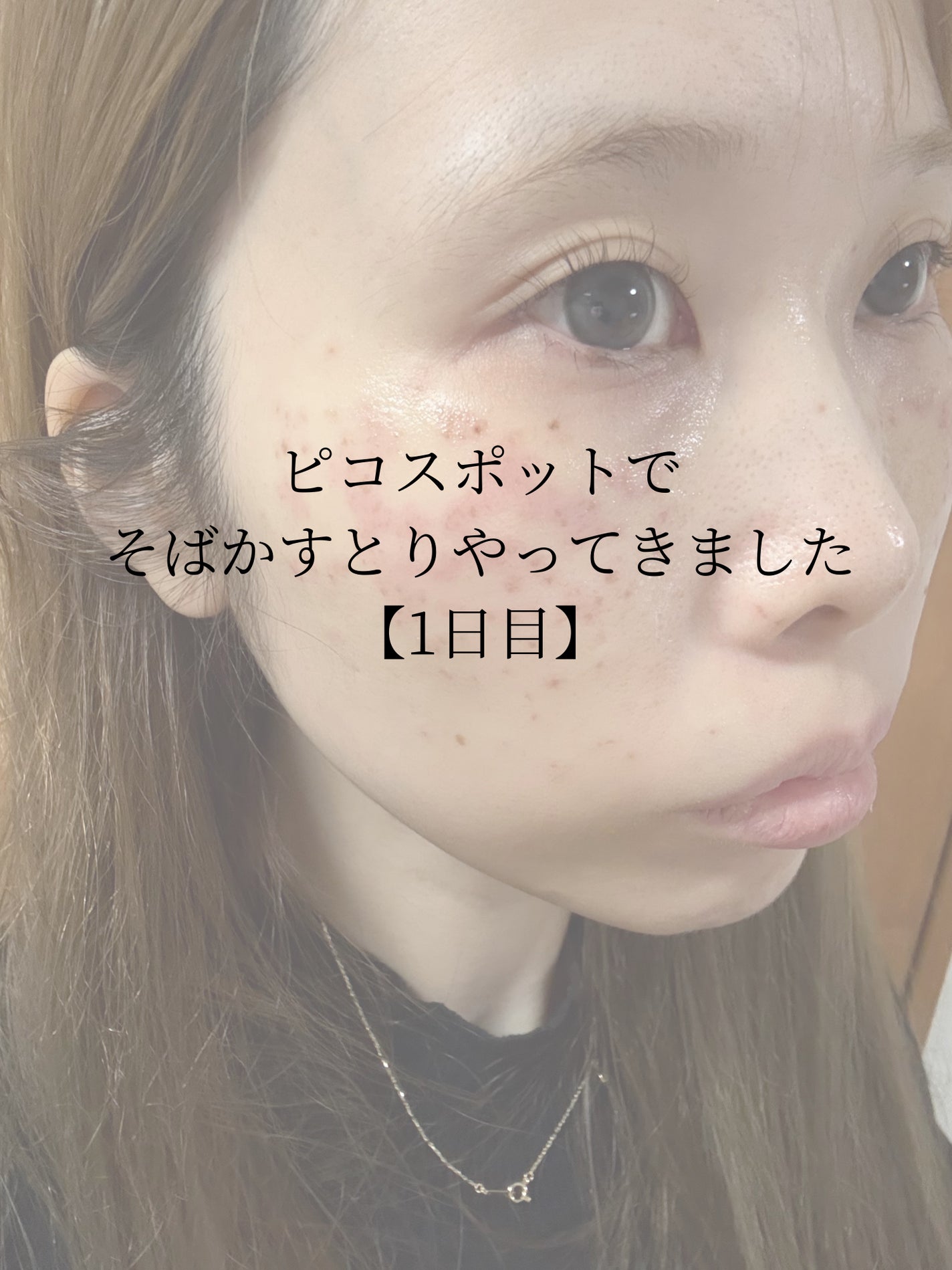 春風ゆうか🧸フォロバ100 on LIPS 「【動画あり】そばかすとりやってきたのでダウンタイムレポしていき..」(1枚目)