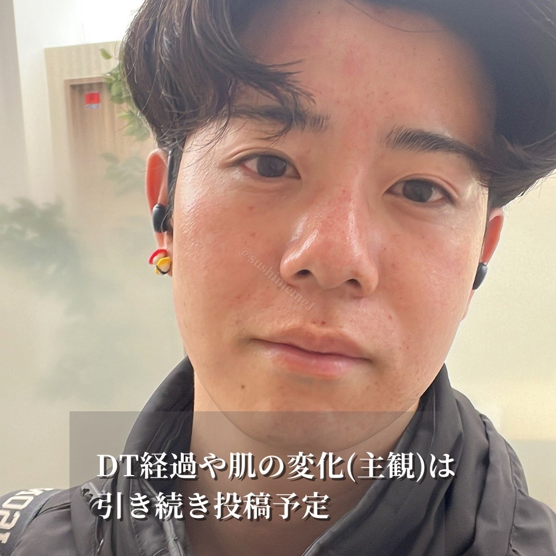 ã¹ã·ãã ð£ on LIPS ããæ¯ç©ŽåŒãç· ãã»å°ãžã¯æ¹åã2025幎ã®çŸå®¹å»ç2æ¬ç®ããã€ã..ãïŒ6æç®ïŒ