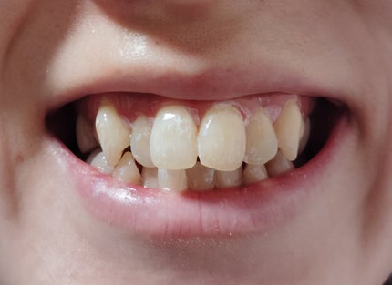 ハニックDC スノー/ハニック・ホワイトラボ/その他オーラルケアを使ったクチコミ(6枚目)