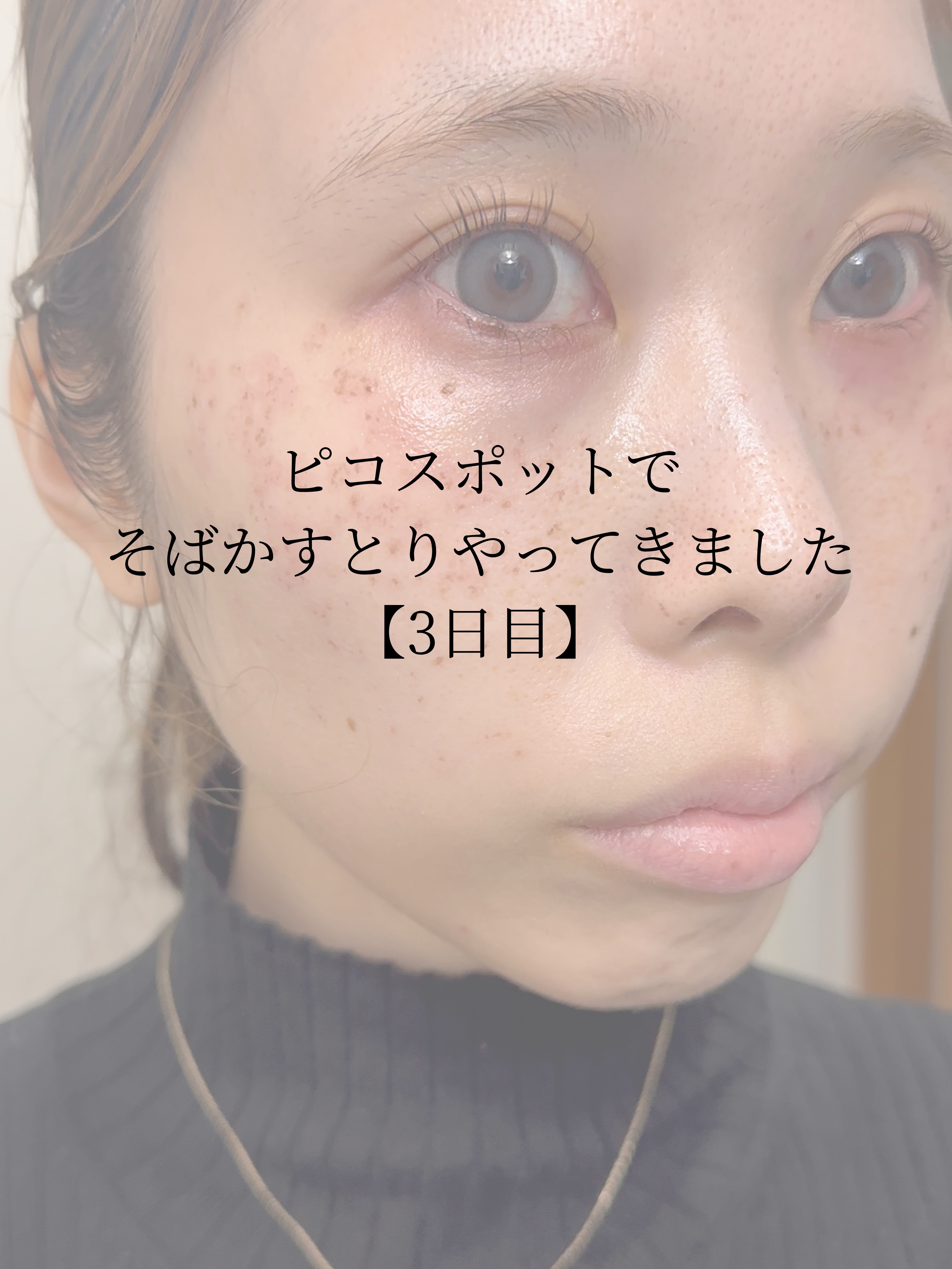 unlabel ラボ V フェイスウォッシュのクチコミ「【動画あり】3日目ー！室内でも洗面所とリビングだと見え方違ったからどっちも載せます💭


濃く.....」（1枚目）