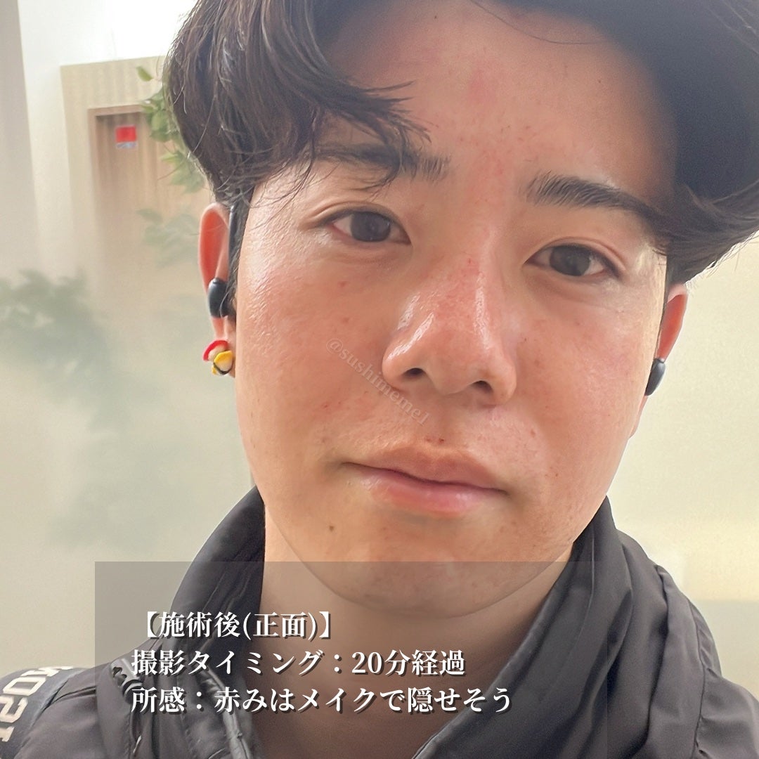 ã¹ã·ãã ð£ on LIPS ããæ¯ç©ŽåŒãç· ãã»å°ãžã¯æ¹åã2025幎ã®çŸå®¹å»ç2æ¬ç®ããã€ã..ãïŒ5æç®ïŒ