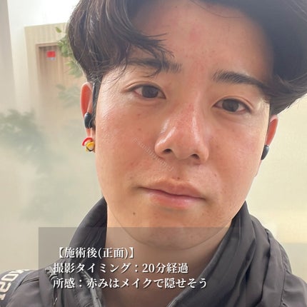 ã¹ã·ãã ð£ on LIPS ããæ¯ç©ŽåŒãç· ãã»å°ãžã¯æ¹åã2025幎ã®çŸå®¹å»ç2æ¬ç®ããã€ã..ãïŒ5æç®ïŒ