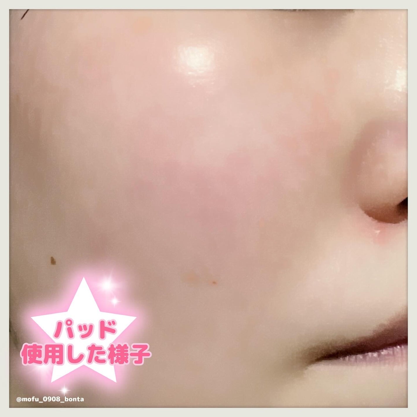 センテラ クイックカーミングパッド/SKIN1004/トナーパッドを使ったクチコミ(4枚目)