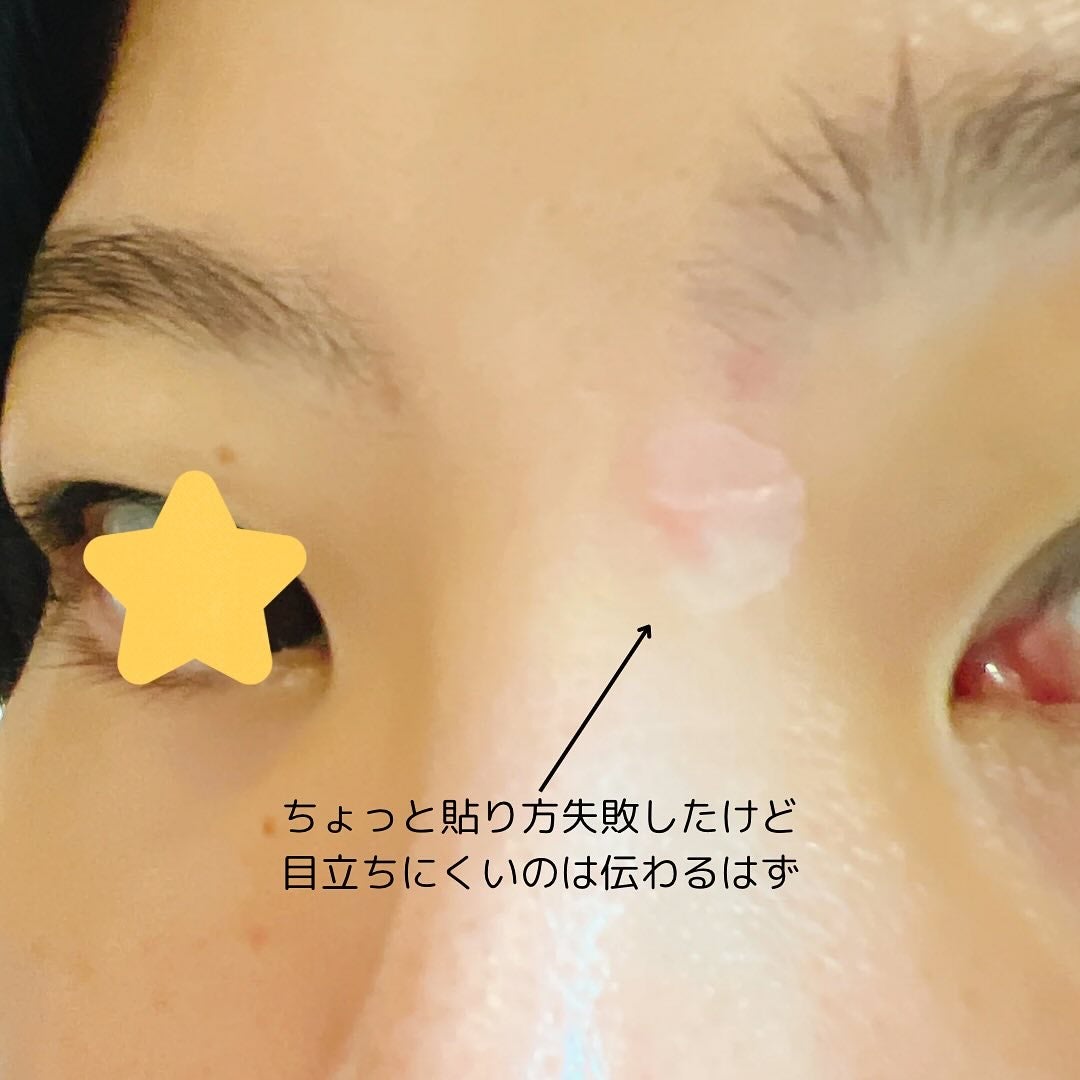 極薄透明パッチ nikipa!/金冠堂/にきびパッチを使ったクチコミ(5枚目)