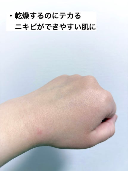 ミノン アミノモイスト 薬用アクネケア ローション/ミノン/化粧水を使ったクチコミ(5枚目)