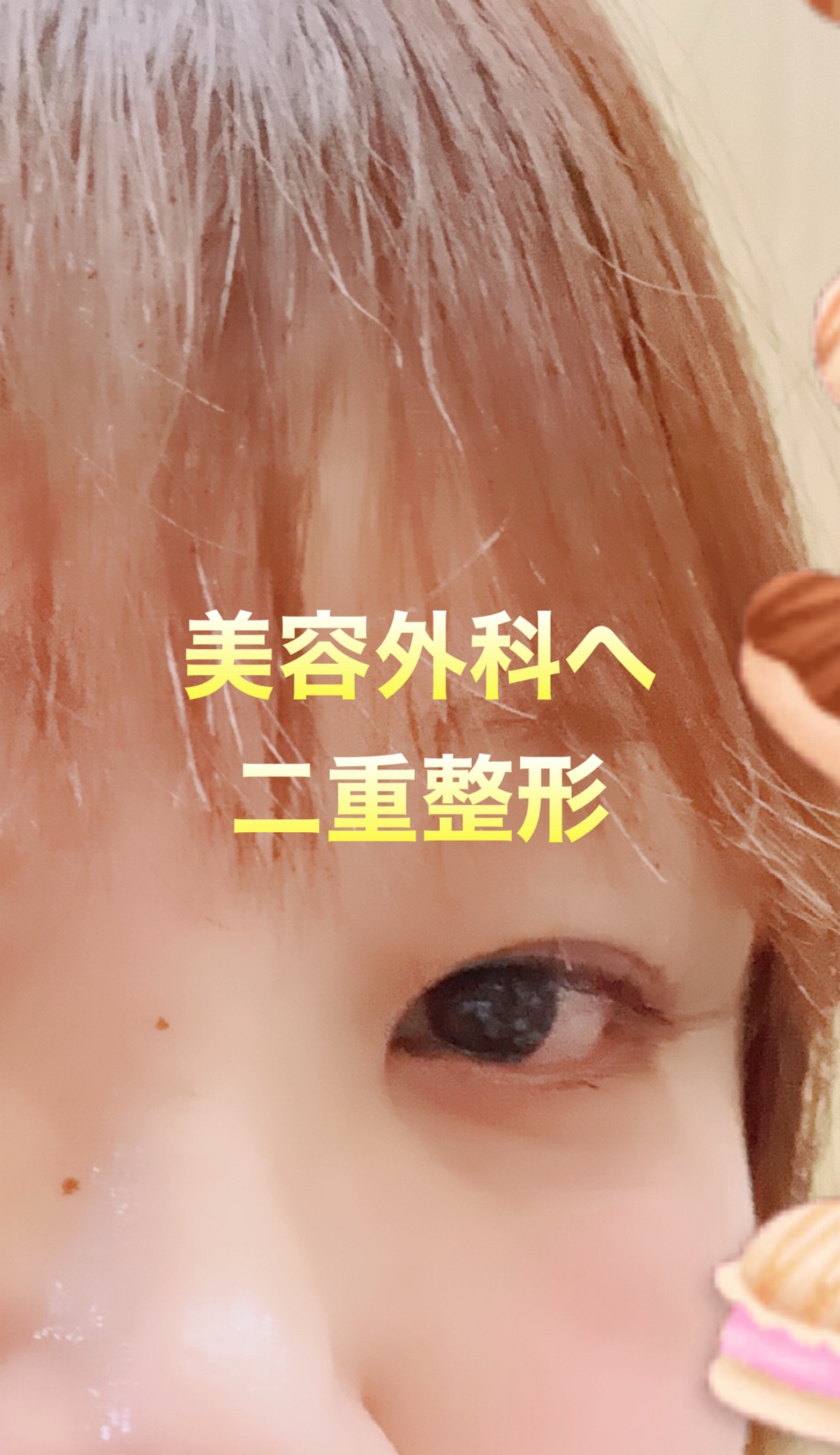 #美容外科

#整形

#二重整形

#平行二重

#ダウンタイム

#ビフォーアフター




1日目


経過観察




勇気いた。


お金も予定より高かった



アラフィフで

眼瞼下垂気味で

太ってかまぶたの脂肪が邪魔をして