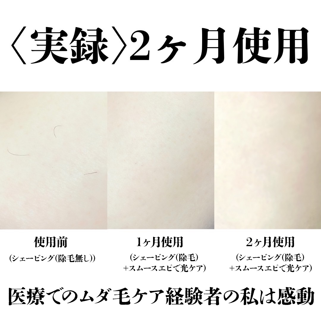 光エステ スムースエピ ES-WG0A/Panasonic/家庭用脱毛器を使ったクチコミ（3枚目）