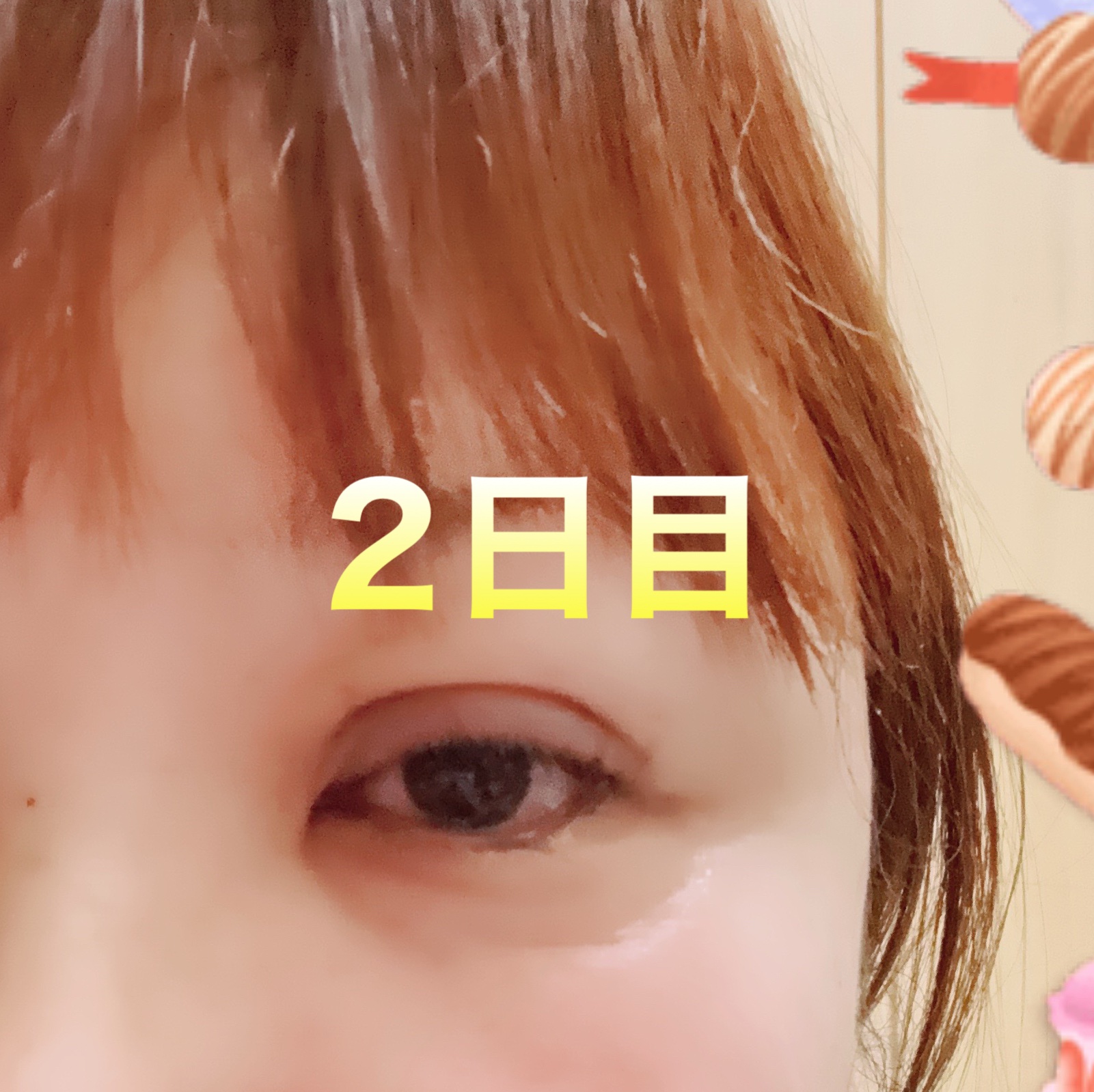 #二重整形

#整形外科

#ダウンタイム




