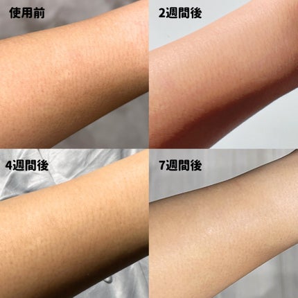 光エステ スムースエピ ES-WG0A/Panasonic/家庭用脱毛器を使ったクチコミ(9枚目)