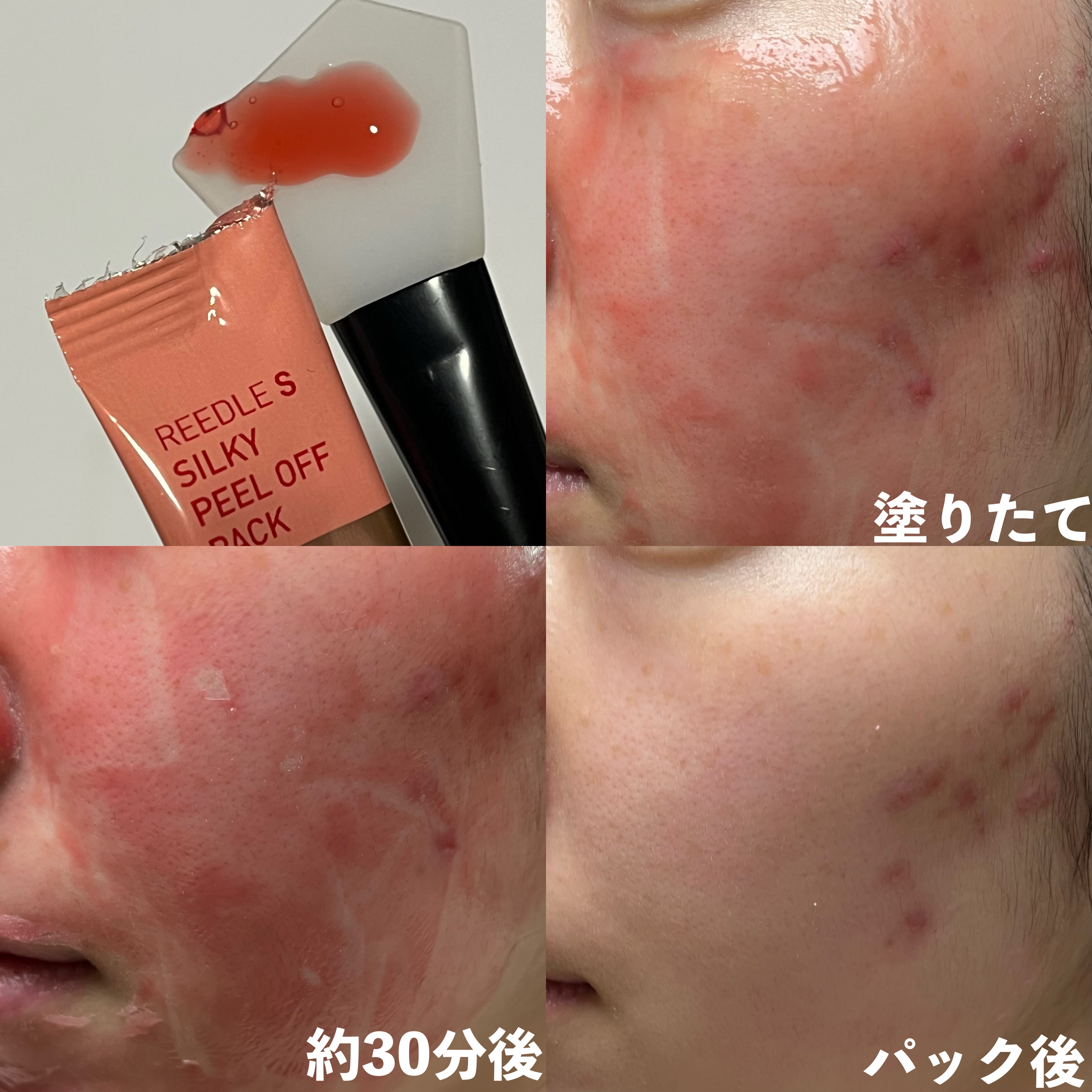 リードルS ピールオフパック/VT/シートマスク・パックを使ったクチコミ（3枚目）