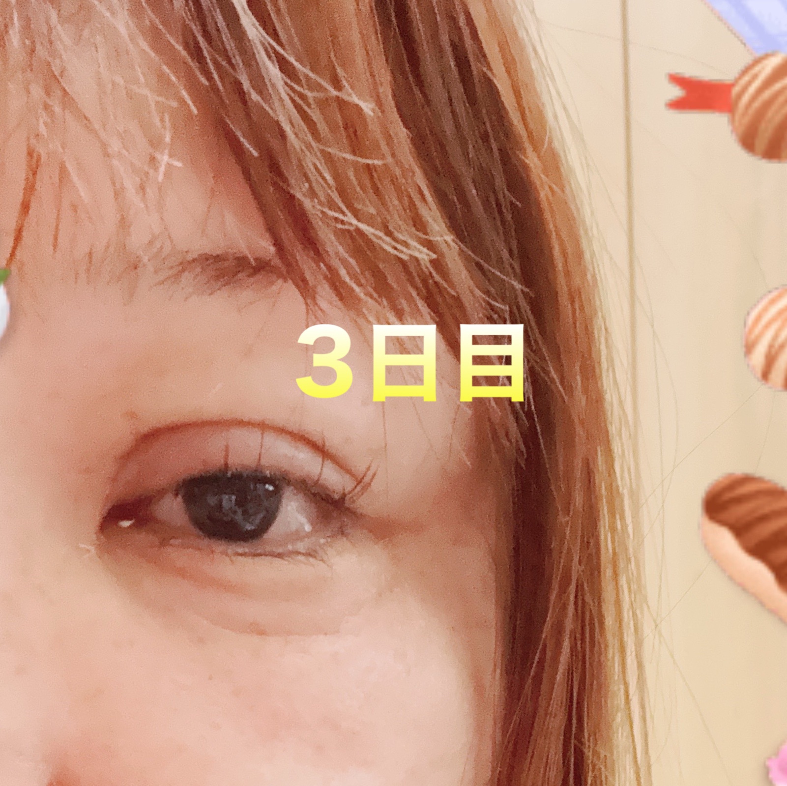 #二重整形


#平行二重


#埋没法



#ダウンタイム




