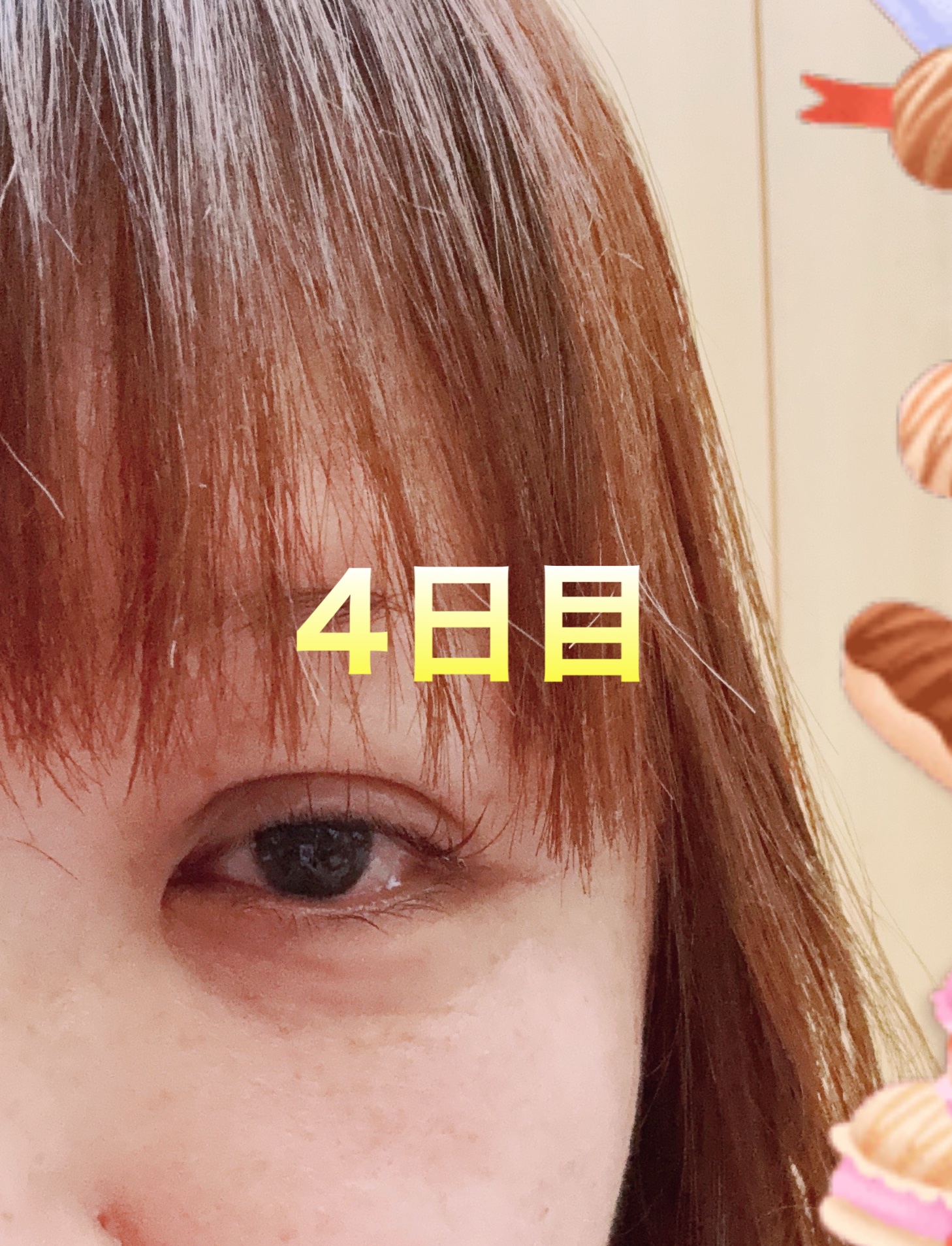 #埋没法

#美容外科

#眼瞼下垂



#ダウンタイム


だいぶ良くなった
気がする