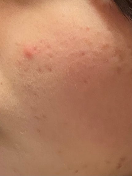 あぽろ on LIPS 「#ニキビ跡#にきび ..」(4枚目)