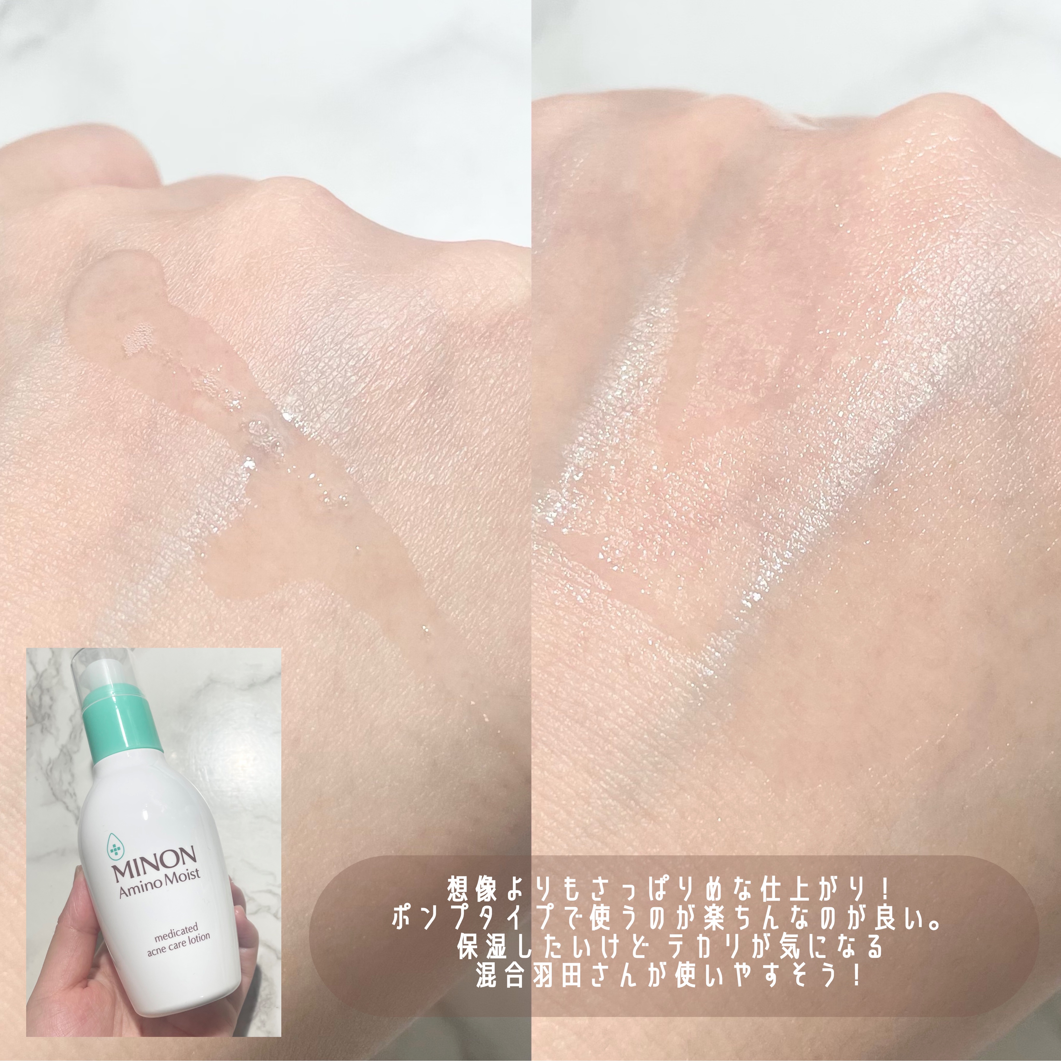 ミノン アミノモイスト 薬用アクネケア ミルク/ミノン/乳液を使ったクチコミ（3枚目）