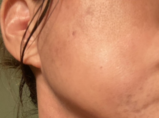 QuSomeホワイト2.0/b.glen/美容液を使ったクチコミ（3枚目）