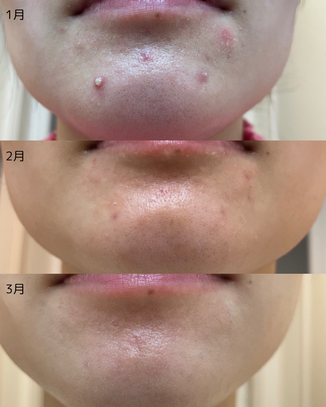 マジックティーツリーオイル/ブラン/フェイスオイルを使ったクチコミ（2枚目）