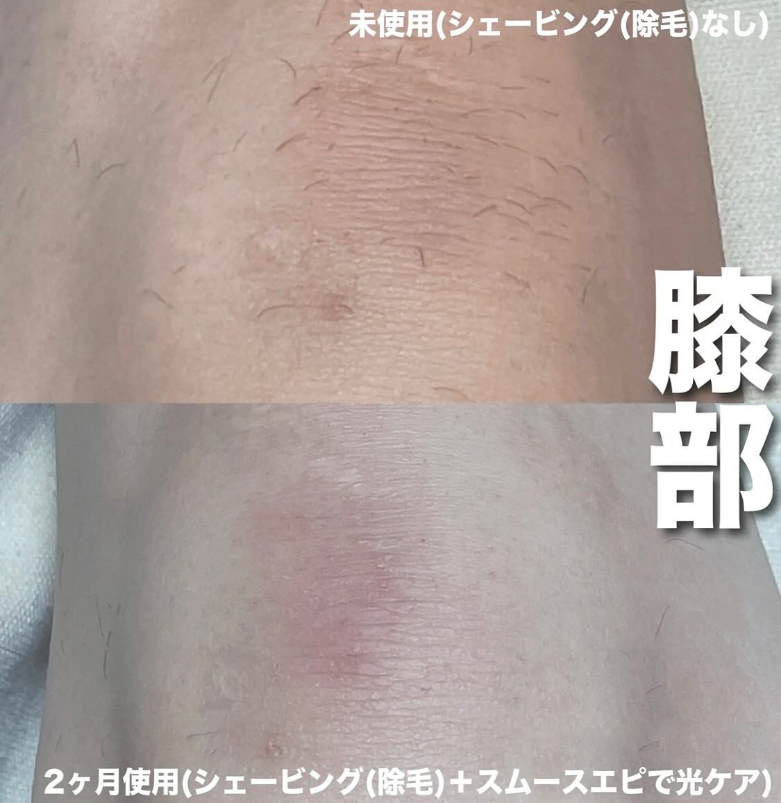 光エステ スムースエピ ES-WG0A/Panasonic/家庭用脱毛器を使ったクチコミ(5枚目)