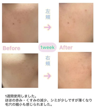 リードルショット300/VT/美容液を使ったクチコミ(4枚目)