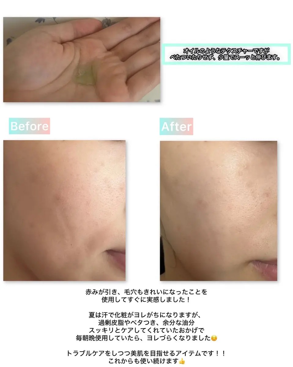 アゼライン酸15 インテンスカーミングセラム/Anua/美容液を使ったクチコミ（2枚目）