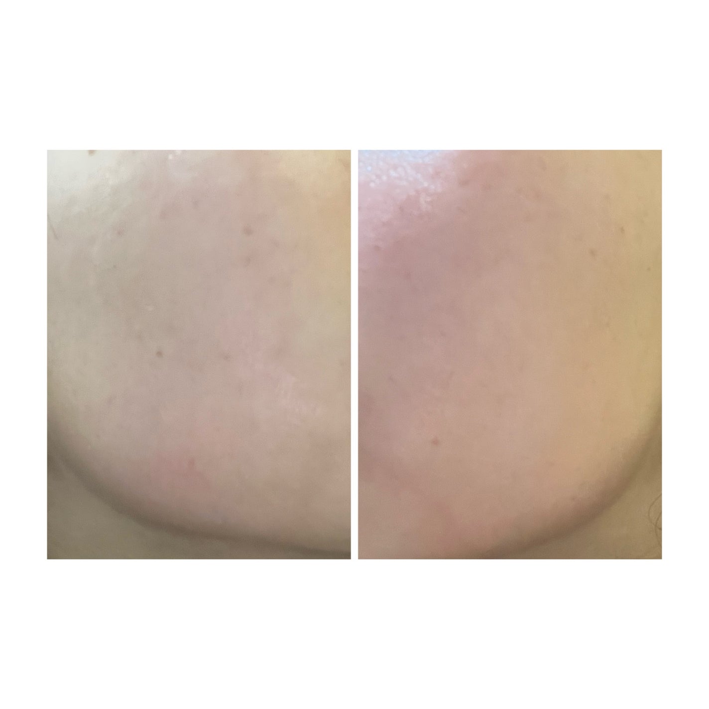 ぽむ on LIPS 「2023.9.13皮膚科に受診 エピデュオとヘパリン処方1枚目..」(4枚目)