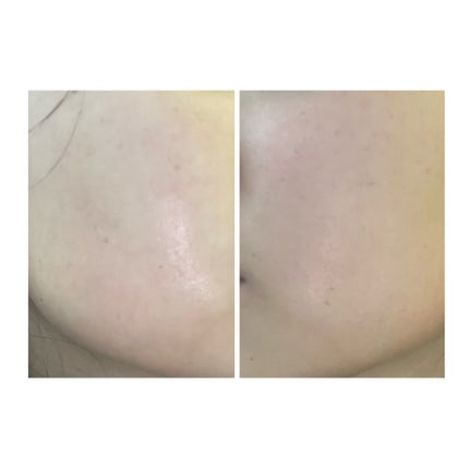 ぽむ on LIPS 「2023.9.13皮膚科に受診 エピデュオとヘパリン処方1枚目..」(5枚目)