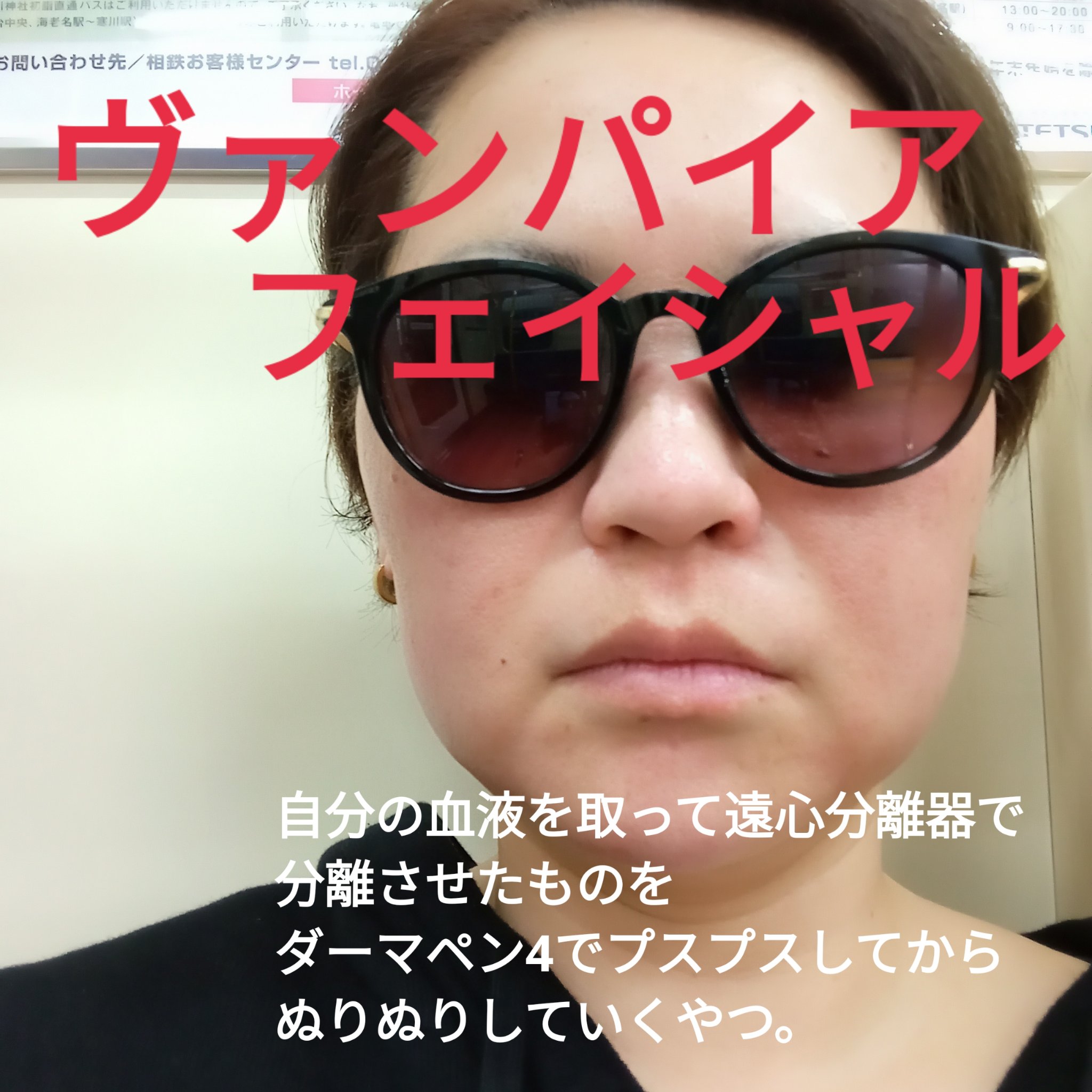 ヴァンパイアフェイシャル/セシリアクリニック/その他を使ったクチコミ（1枚目）