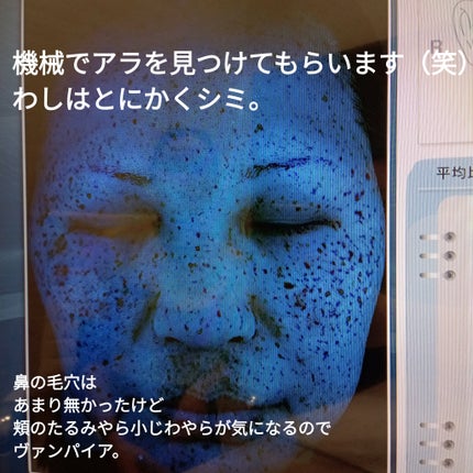 ビヨンセ奥二重向上委員長🥸LIPSパートナー🥳 on LIPS 「⚠️速報⚠️セシリアクリニック横浜院さんでヴァンパイアフェイシ..」(5枚目)