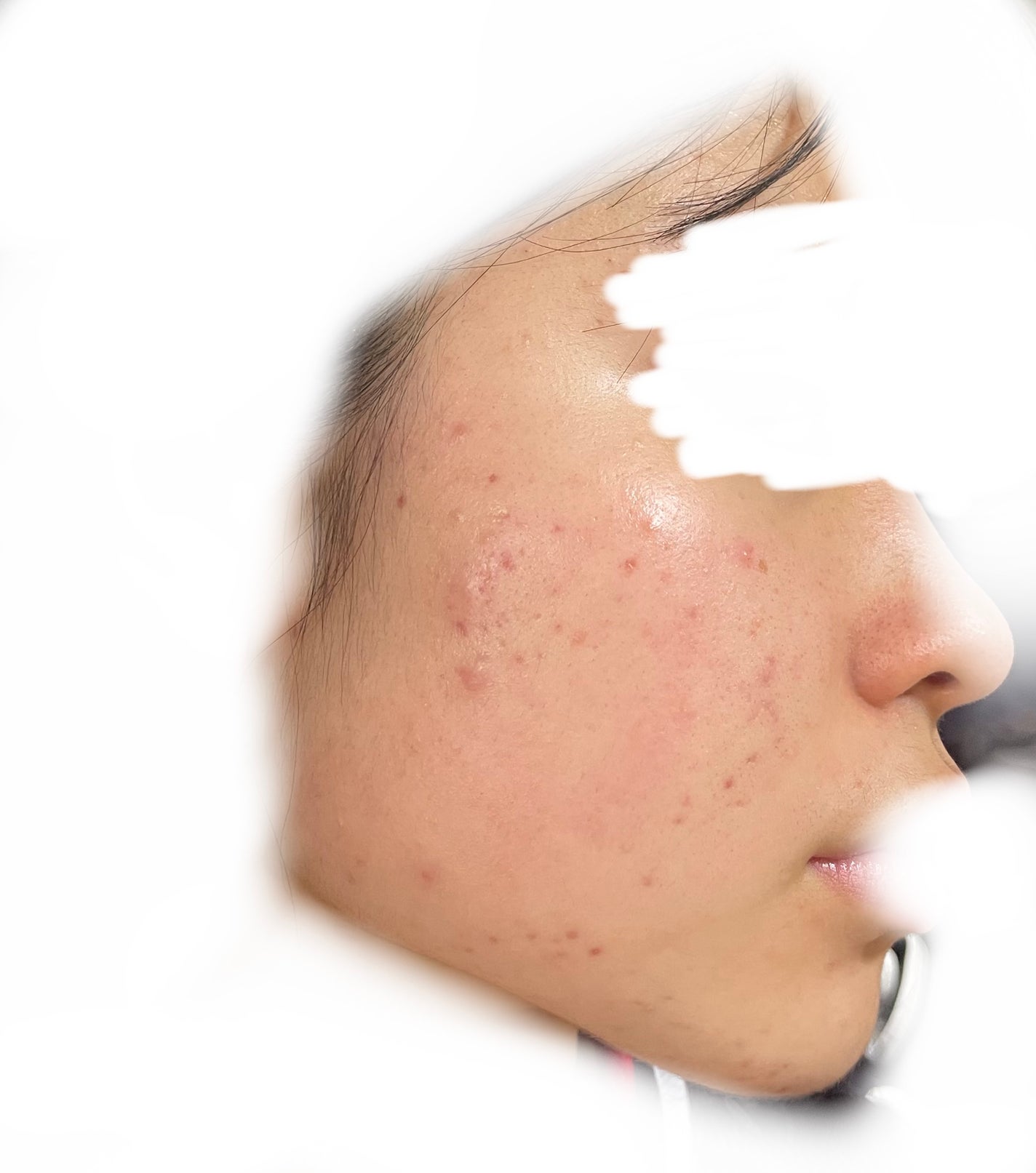 あぽろ on LIPS 「ニキビ跡の治し方知りたいです#ニキビ#ニキビ跡..」(1枚目)