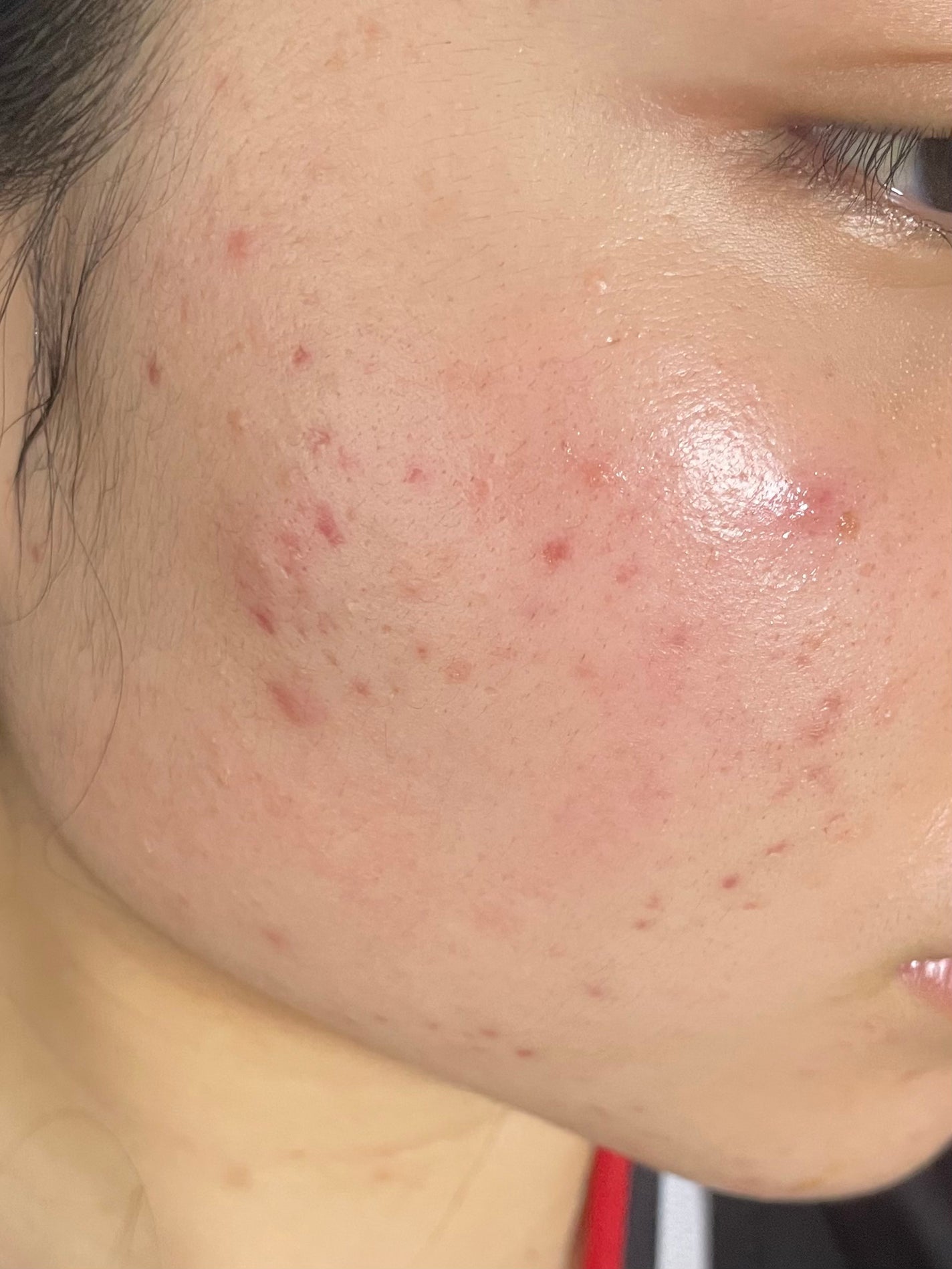 あぽろ on LIPS 「#ニキビ跡..」(1枚目)