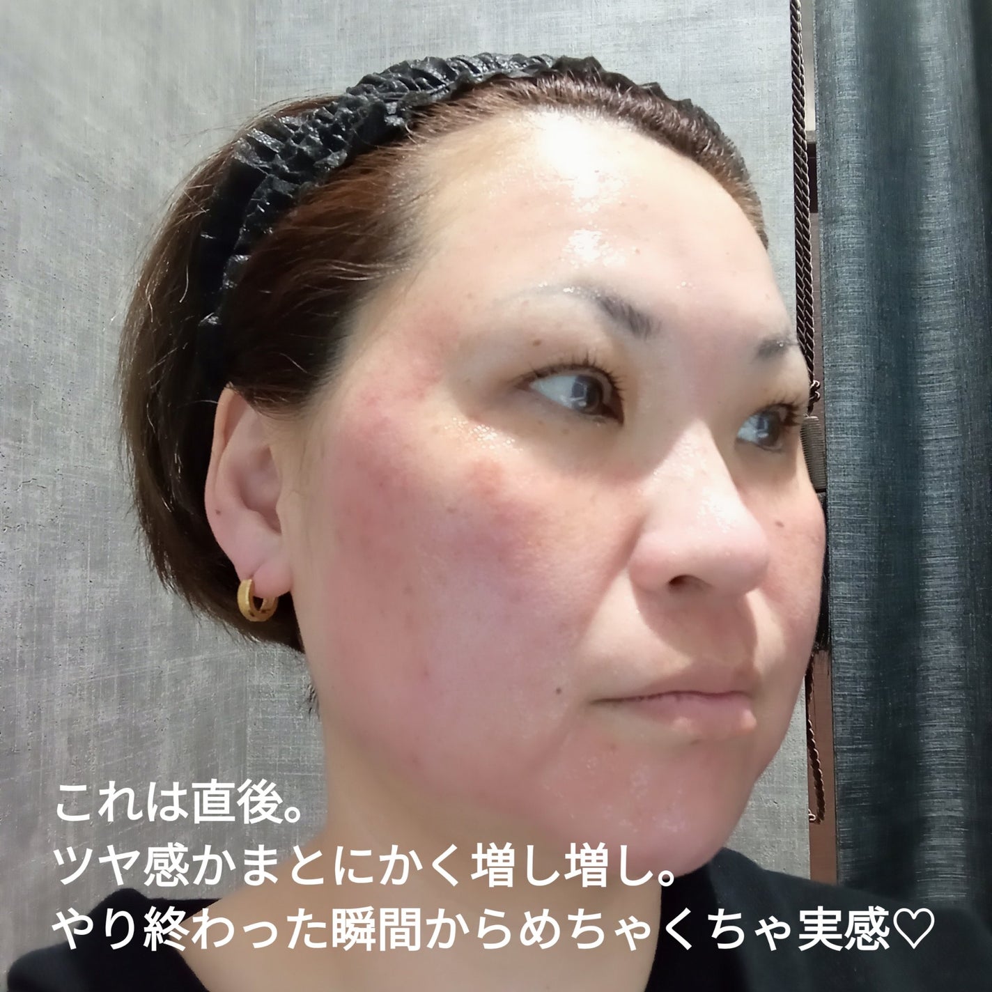 ビヨンセ奥二重向上委員長🥸LIPSパートナー🥳 on LIPS 「⚠️速報⚠️セシリアクリニック横浜院さんでヴァンパイアフェイシ..」(8枚目)