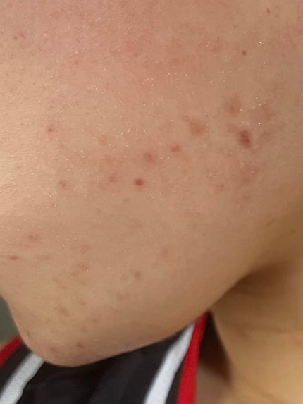 あぽろ on LIPS 「#ニキビ跡..」(4枚目)