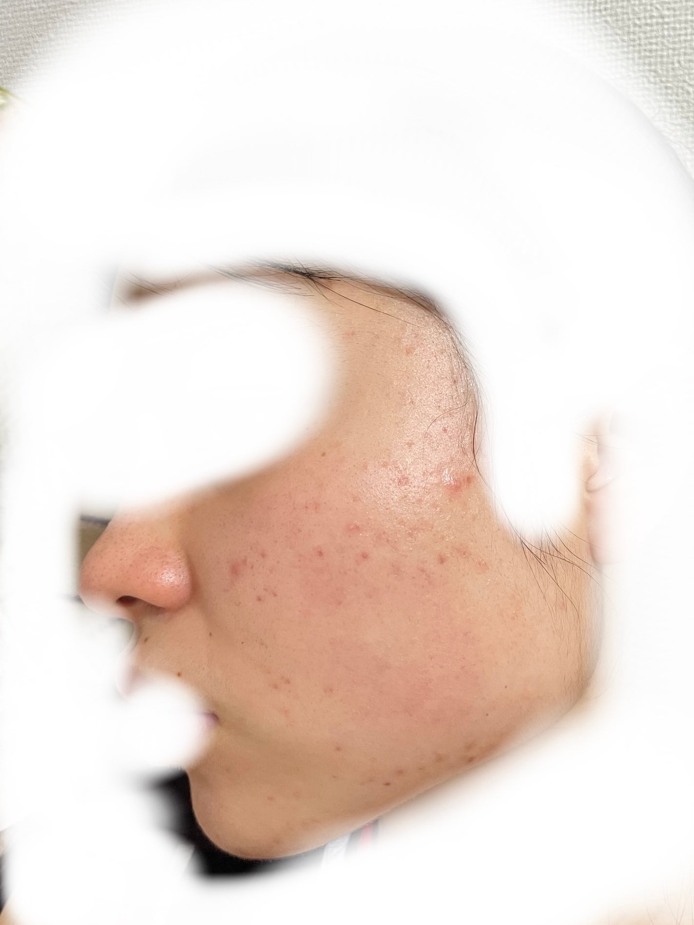 あぽろ on LIPS 「ニキビ跡の治し方知りたいです#ニキビ#ニキビ跡..」(2枚目)