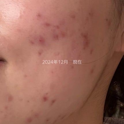 星空(sea) | ニキビ肌治す ෆ ̖́- on LIPS 「こんにちは星空(sea)です☺︎ご覧いただきありがとうございま..」(5枚目)