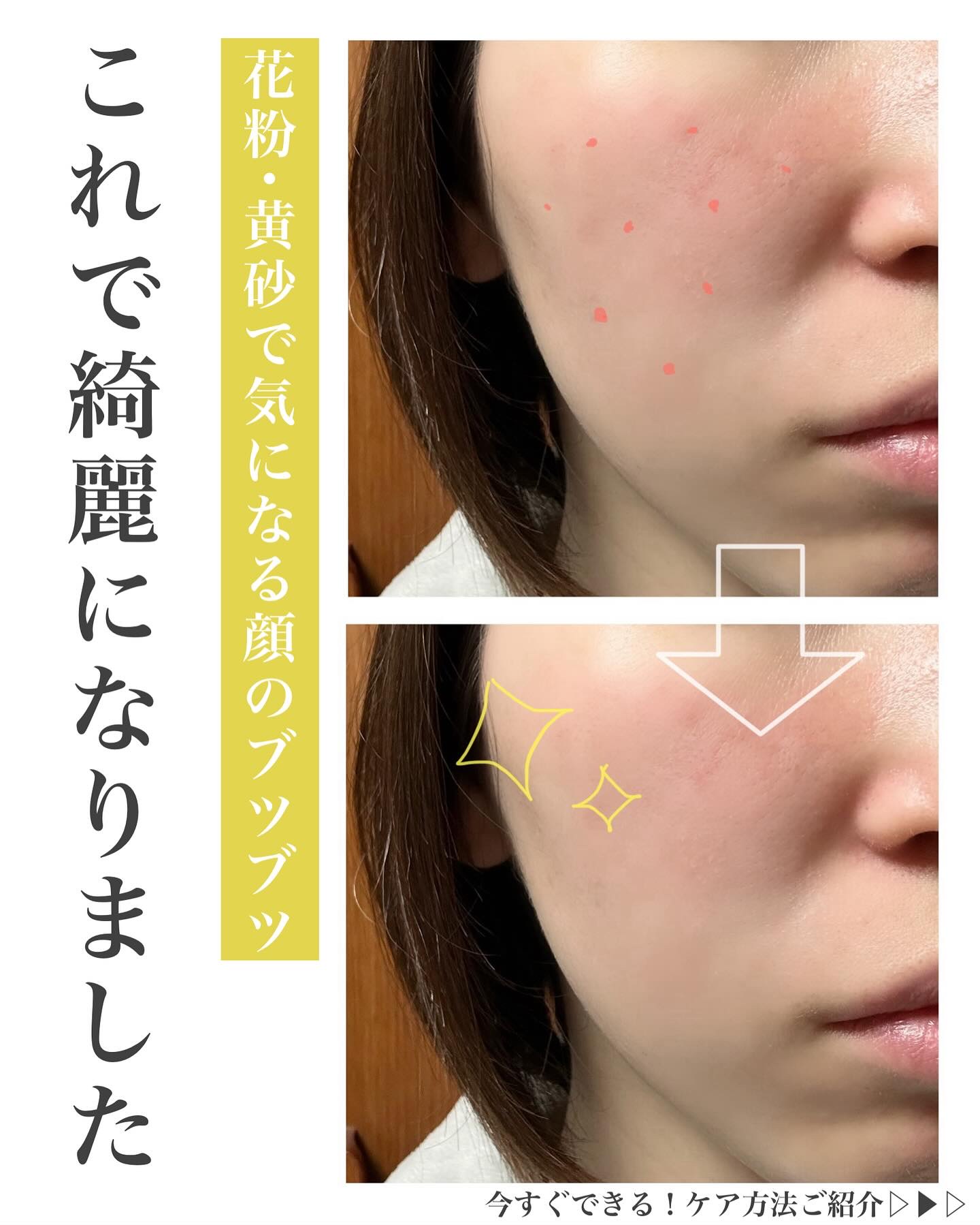 アレルバリア ミスト/d プログラム/ミスト状化粧水を使ったクチコミ（1枚目）