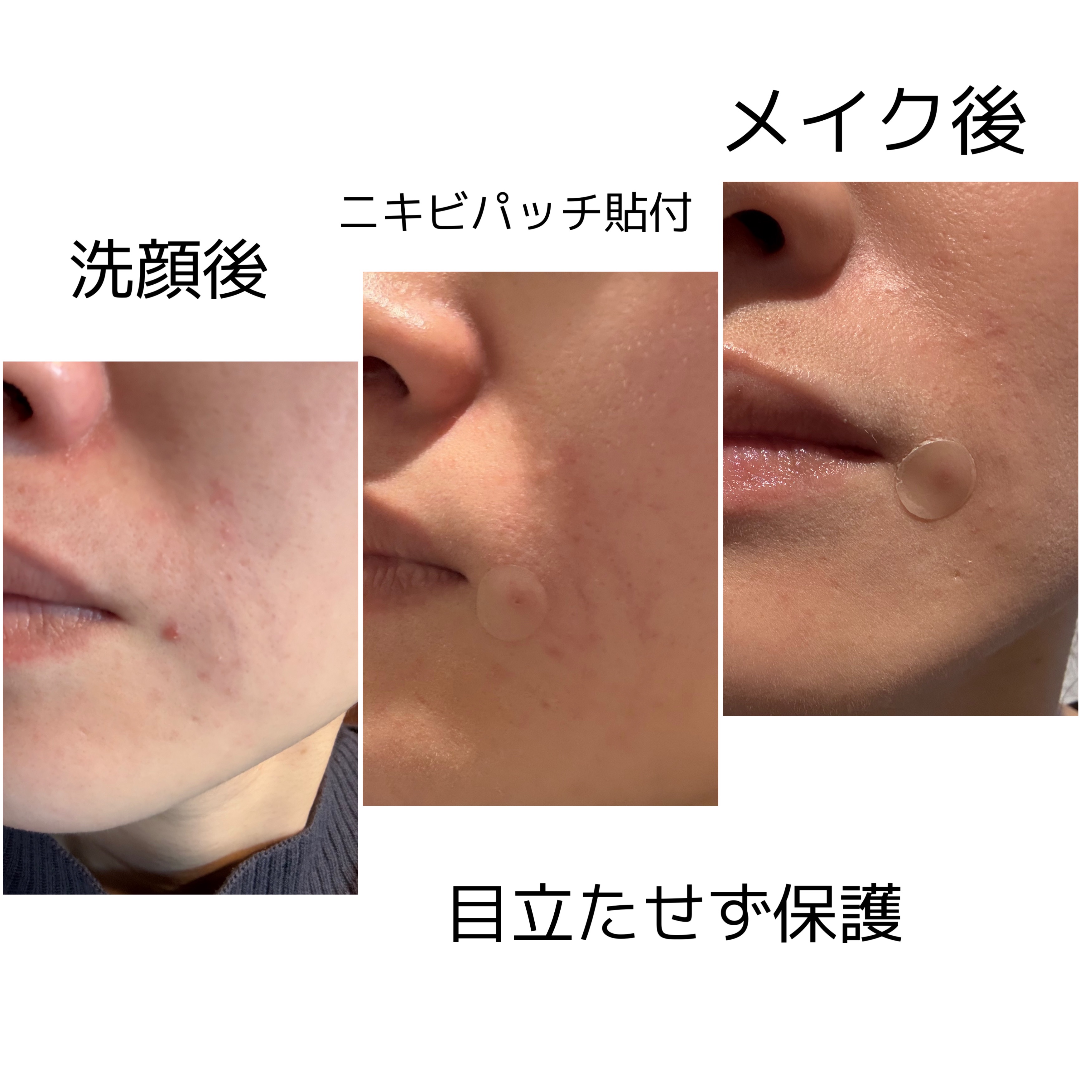 スポットイレイザー/NOLAHOUR/その他を使ったクチコミ（2枚目）