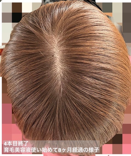 薬用 メディカル アンチヘアロスセラム/L'OCCITANE/頭皮ローションを使ったクチコミ(4枚目)