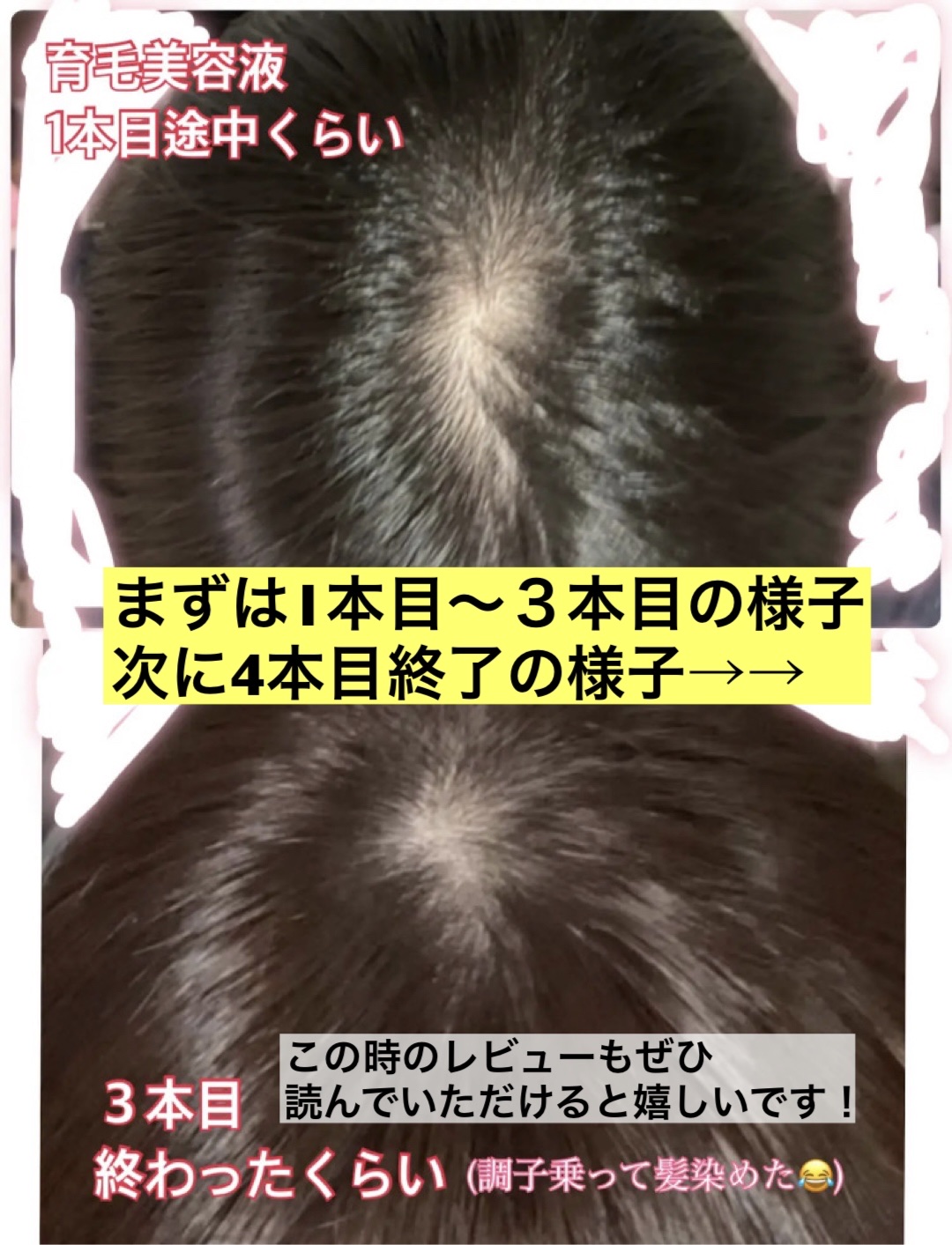 薬用 メディカル アンチヘアロスセラム/L'OCCITANE/頭皮ローションを使ったクチコミ（2枚目）