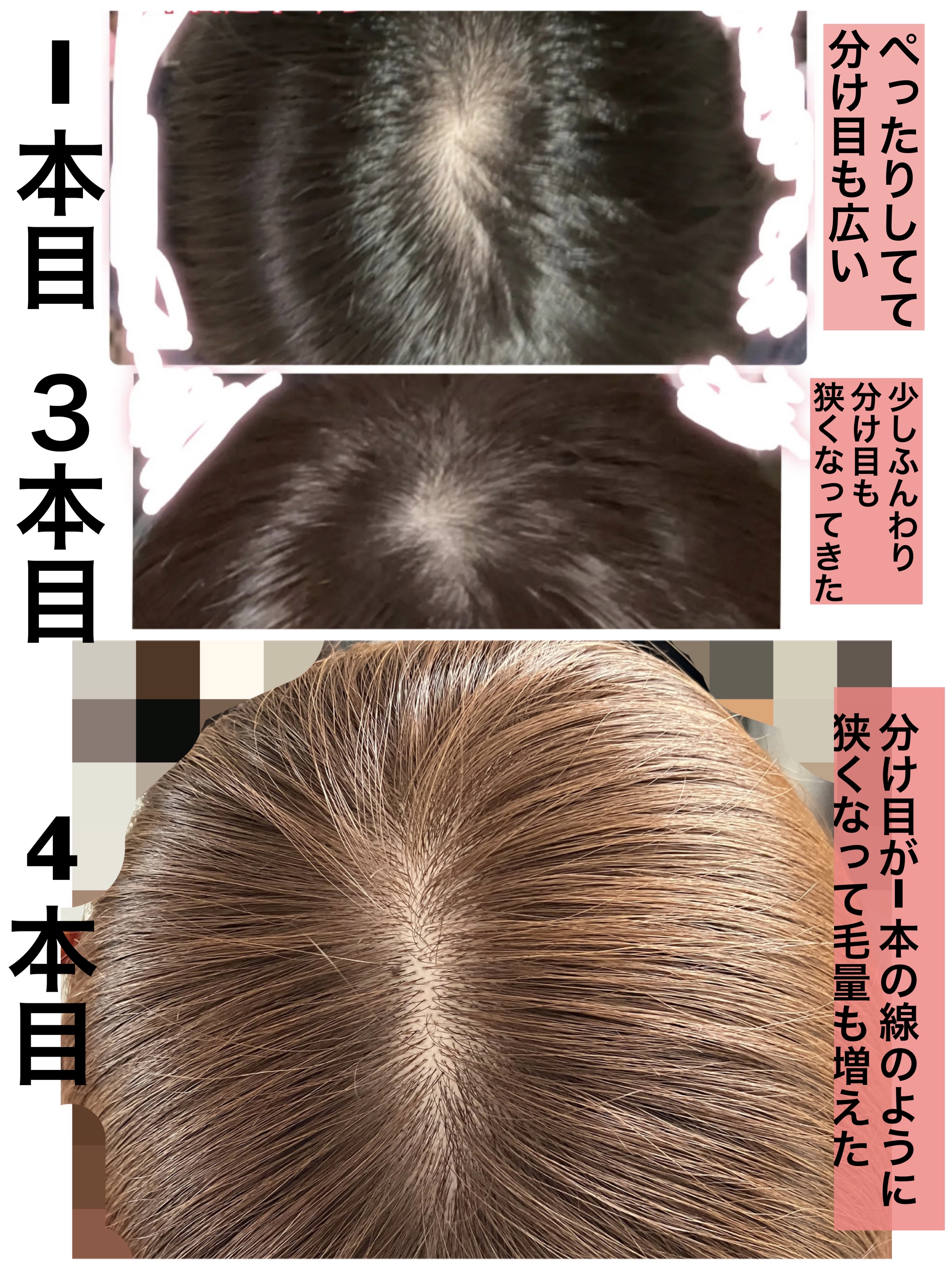 薬用 メディカル アンチヘアロスセラム/L'OCCITANE/頭皮ローションを使ったクチコミ（3枚目）
